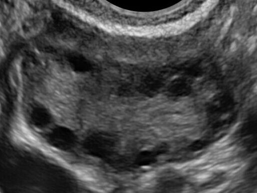PCOS_echo_shema:卵巣に小さな卵胞(黒丸)がたくさん見える
